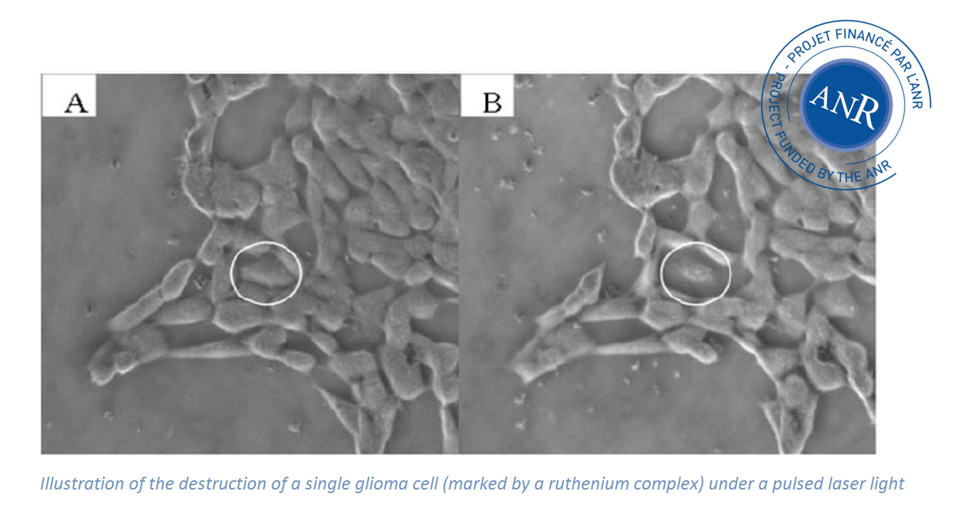 Illustration of the destruction of a single glioma cell (marked by a ruthenium c