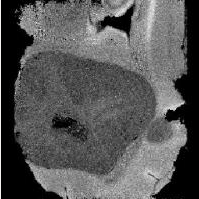 Glioblastome de cerveau de rat